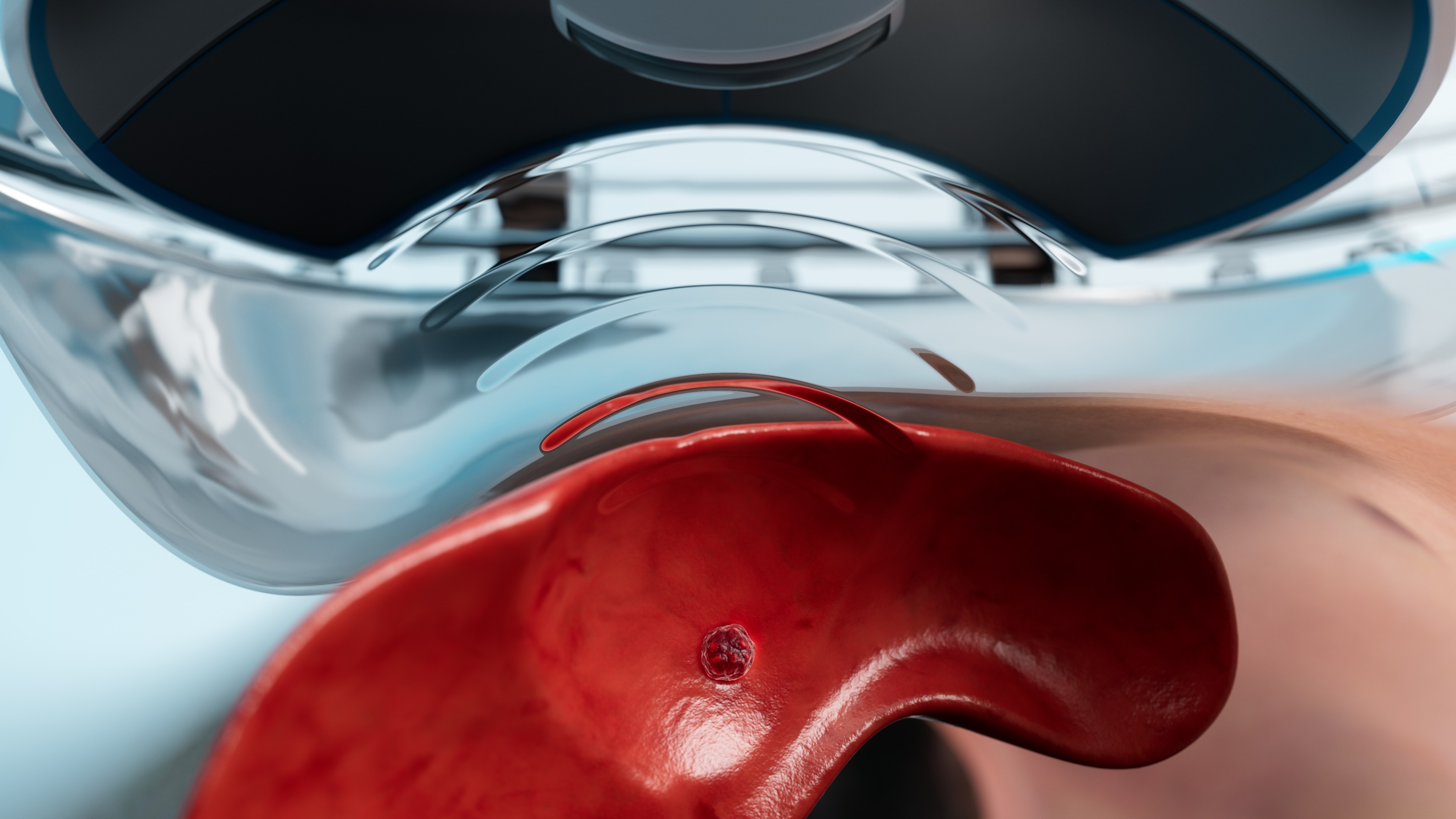 Courtesy of HistoSonics - Histotripsy-Tumor-Ultrasound