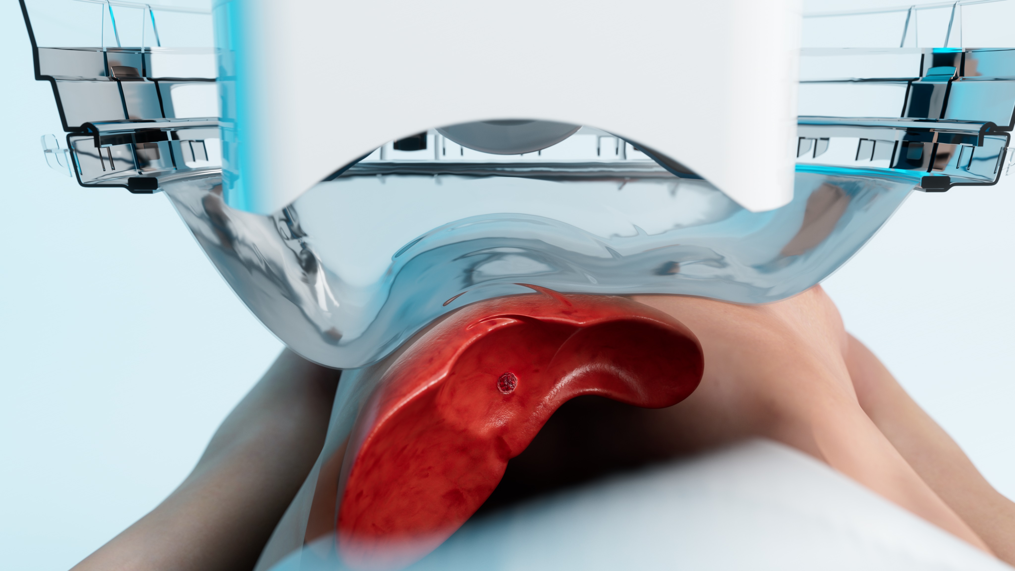Courtesy of HistoSonics - Patient-Liver-with-Patient-Membrane