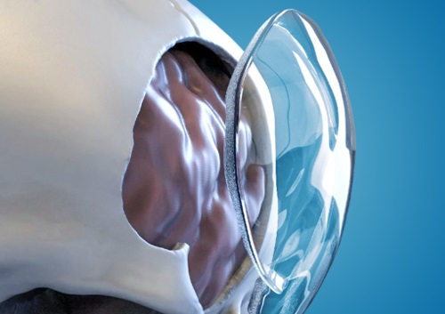 Longeviti skull implant