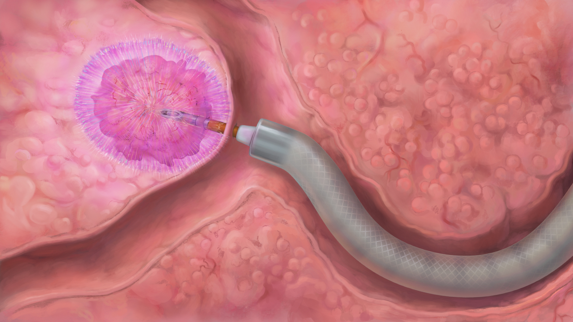 INUMI Flex Endoscopic Needle in Action25